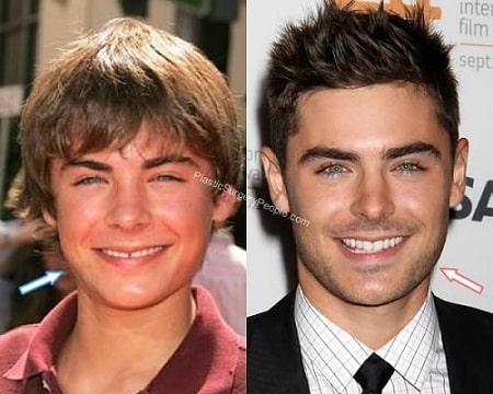 Zac Efron before (left) and after (right).